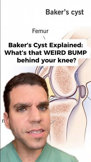 Bakers cyst explained: What’s that WEIRD BUMP behind your knee?