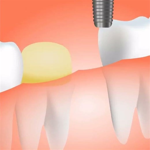 TOOTH PREPARATION