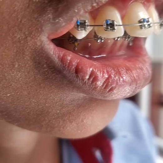 overjet and overbite are really disgusting in children, they cause loss of self esteem. #fyp #harmonydentalclinic #overjet #overbite #dentalbite #dentalbiteproblems