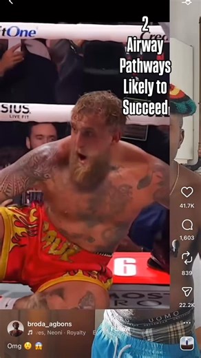 Jose Dionisio Torres Jr on Instagram: "RSI is used so much that many are Unwise enough to rsi this patient if he was in airway extremis. Some would want to break the wires connecting his broken jaw together. I know they would just to intubate via the mouth. If you can pre oxygenate this patient and sit him up. Awake. Nasal fiberoptic intubation on 1 try would be best, Unwise folks take a look then take 30 minutes to dunk your et tubes in superhot water to make the tubes soft and bendy. Nasal pre