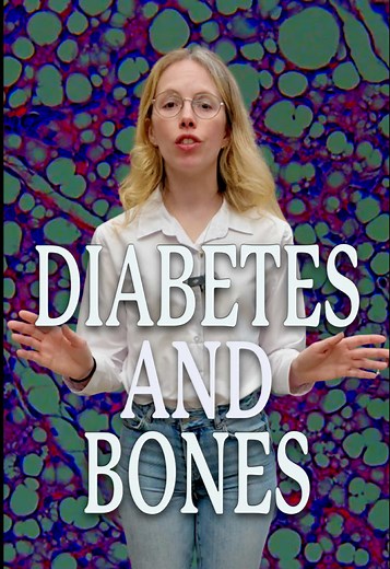 Diabetes Impact on Bone Health