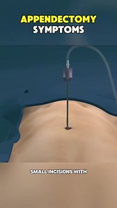 Appendectomy symptoms #surgery #appendectomy #appendectomyrecovery #appendectomycheck #appendectomyscar #appendectomysymptom #symptoms #symptomsofappendectomy #appendectomyprocedure #appendectomyrecoverytime #appendectomyawareness | Mix Dancing Events