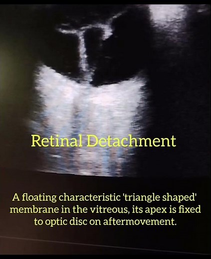 B scan of Retinal Detachment.