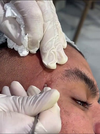 ‏#basemkhaled123 #blackheads #رؤوس_سوداء #تنظيف_بشره