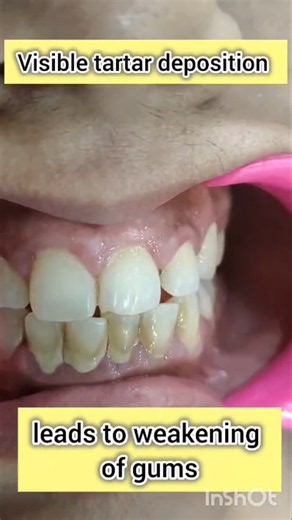 Tartar on your teeth? Smile Makeover alert! #smile #tartar #teeth