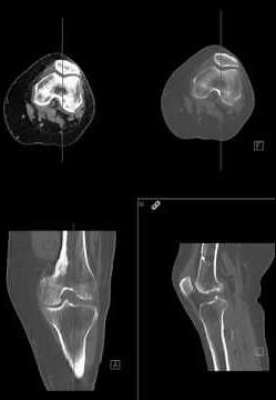 Knee CT imaging plane prescription