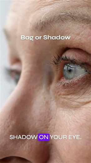 Lower eyelid lifts need fat grafting—here's why...