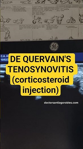 De Quervain’s tenosynovitis (Corticosteroid injection)