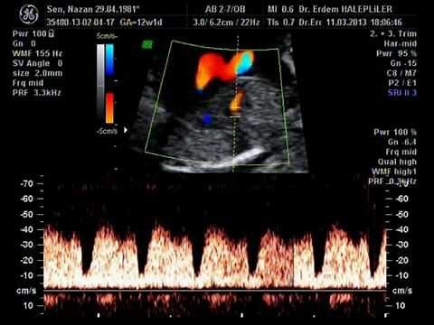 ductus venosus doppler