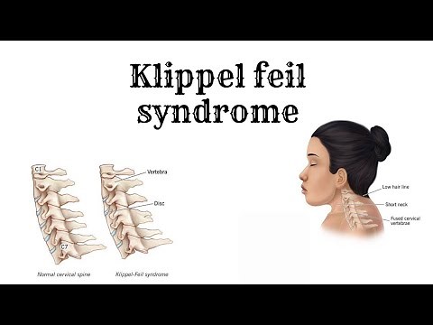 Everything about KLIPPEL FEIL Syndrome