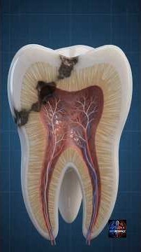 🦷 What Happens Inside Your Tooth When You Get a Cavity? | Tooth Decay Explained |