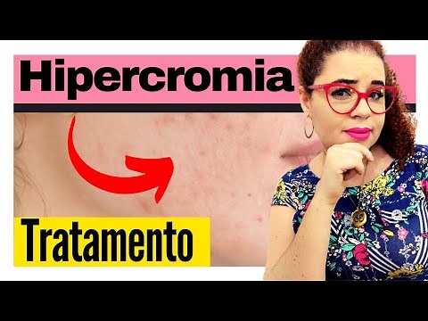 Hipercromias (manchas escuras na pele) - Como tratar?
