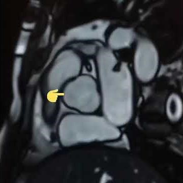 CINE TRUEFISP of Heart Cardiac MRI