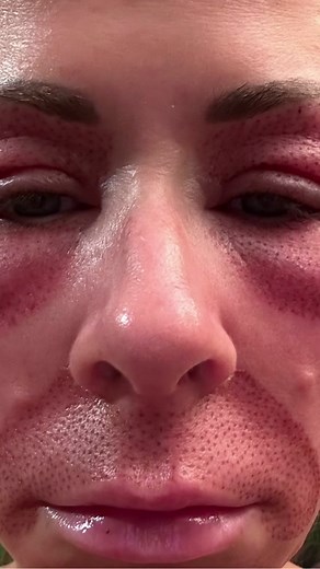 Dropping dots! Day 5 is a great day! #fibroblast #fibroblastplasma #plasmapentreatment #plasmapenfibroblast #aesthetic #estheticiantiktok #skintok #skincare #skinhack #skintips #skintightening #wrinkletreatment #40something #thisis40something #aginggracefully #iowa #lasertreatment #cosmetictreatment #aging #skinroutine #makeup #laserwork #facialtreatment #facial #undereyebags #skintextureimprovement