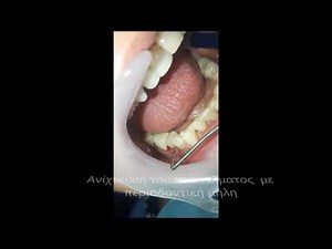 Αποστημα δοντιου με περιοδοντίτιδα -Dr. med. dent Μαρίζα Δημητρούλη