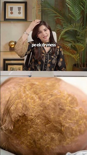 Dr. Kanza explains what cradle cap is and how to treat it safely at home.