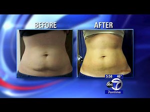 How CoolSculpting works