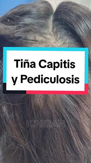 Tiña Capitis: Consecuencias, Contagio y Tratamiento