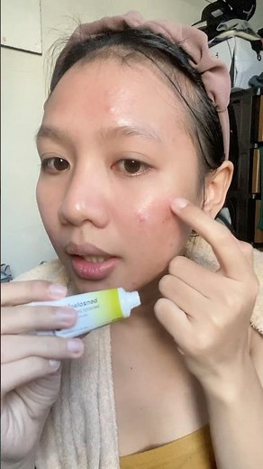 How to use benzolac for acne