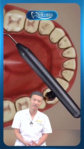 Close-up on Dental Calculus, Plaque Blasted Away in 15 Minutes | Minh Chau Dental Clinic