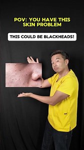 How to treat blackheads