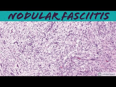 Nodular Fasciitis: 5-Minute Pathology Pearls