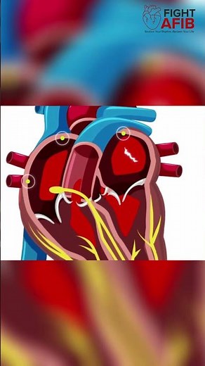 Untreated AFib Gets Exponentially Worse