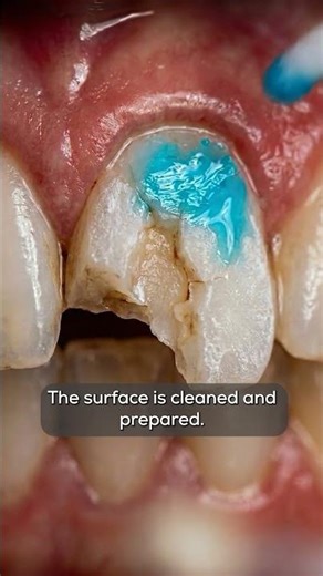 Broken Tooth Reborn! #shorts #teethdecay #repair #dentakings #orthodontist #wisdomtoothextraction