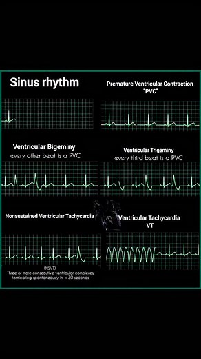 Premature Ventricular Contraction (PVC) Single ectopic beats, often benign - Bigeminy → Every other beat is a PVC - Trigeminy → Every third beat is a PVC Ventricular Tachycardia (VT) - NSVT → 3 consecutive PVCs, stops on its own (
