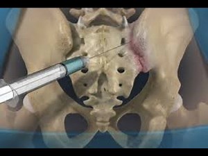 Fluoroscopic Sacroiliac Joint Injection ￼