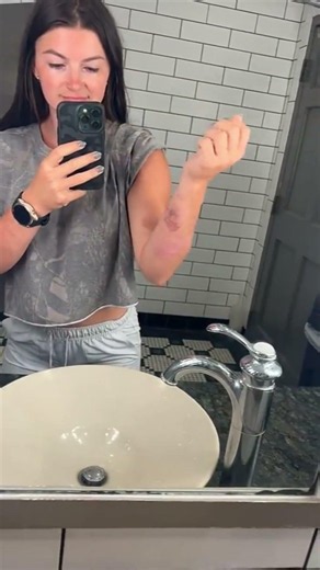 OMG 😱 Hannah Barron broke her hand! catfish kisses! #fitness #dress #outfit #gym