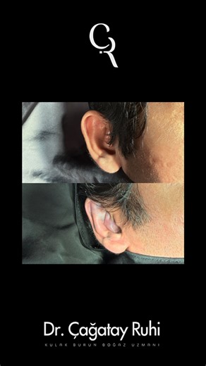 🔸 OTOPLASTY OPERATION We are delighted to share the before and after results of our patient from Canada who recently underwent otoplasty operation. Throughout this process, we aimed for a natural appearance that harmonizes with the patient’s facial features, and their satisfaction has been our greatest motivation! 💫 ✅ Patient’s consent for sharing their images has been obtained. Dr. Çağatay Ruhi, MD clinic is authorized by the Turkish Ministry of Health as an International Health Tourism Cente