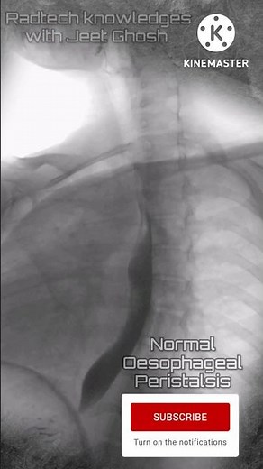 Barium swallow normal oesophagus constriction #radiology #xray #mbbsstudent #shorts