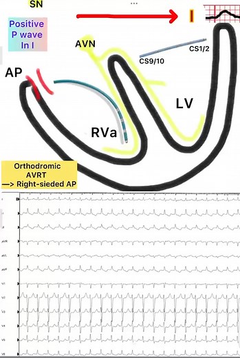 👇 WPW Syndrome : How to Differentiate Between a Right-Sided or Left-Sided Accessory Pathway During Orthodromic AVRT Based on ECG?👇 👉 Long RP tachycardia with a VA interval > 70 ms 👉 Narrow complex tachycardia with a 1:1 atrioventricular relationship 👉 A negative P wave in lead I indicates a left-sided AP 👉 A positive P wave in lead I indicates a right-sided AP 👉 Septal accessory pathways are often associated with a biphasic P wave in lead I | Cardiophilia