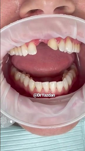 Dental bridge procedure | dental bridge front teeth | dental bridge before and after | Dr. Yazdan