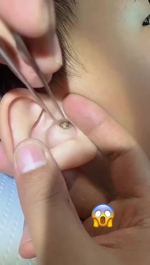 Ear Cleaning Techniques by a Medical Professional