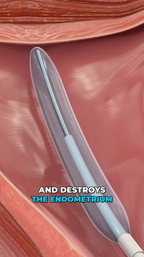 Viz Medical on Instagram: "Thermal balloon endometrial ablation is a procedure used to treat heavy menstrual bleeding. It involves using a heated balloon to destroy the lining of the uterus, reducing or eliminating periods."