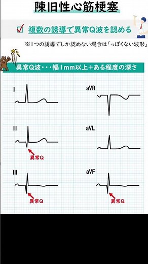 1-minute electrocardiogram "old myocardial infarction" challenge electrocardiogram certification ...