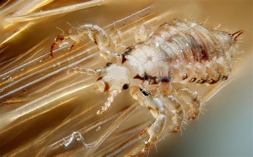 National nit index could help stem the spread of lice