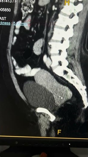 Understanding Carcinoma Cervix: Symptoms and Treatments