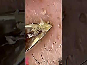 Skincare | Blackheads Removal #176 #skincare skincare #blackheads blackheads