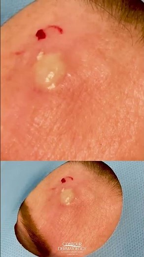 Forehead Cyst Squeezed | CONTOUR DERMATOLOGY #shorts