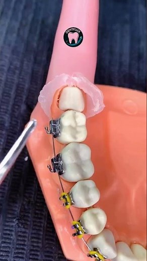 Extraction of impacted 3rd Molar