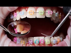 Fun Braces Colors for Kids