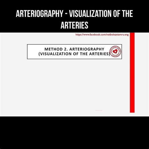 Arteriography - visualization of the arteries