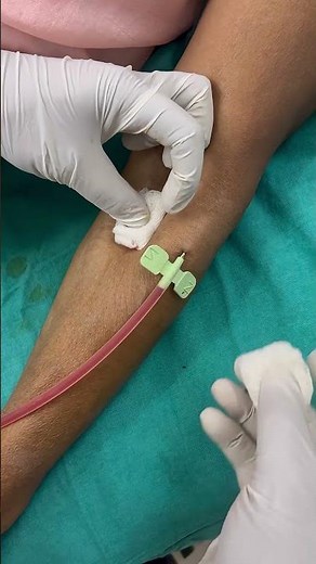 Dialysis AV Fistula Needle Removal Procedure #AVFistula#NeedleRemoval#DialysisProcedure