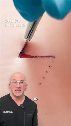 Z-Shaped Scars: Why a Longer Incision + More Sutures Works