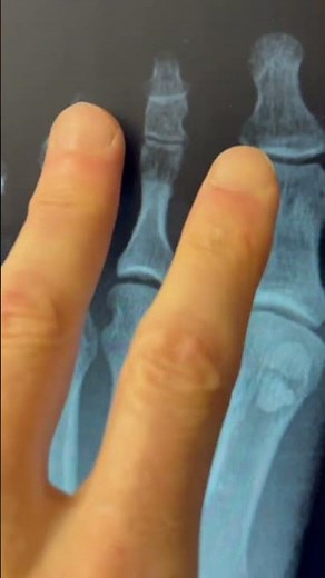 Fit Foot U: What is Metatarsalgia?