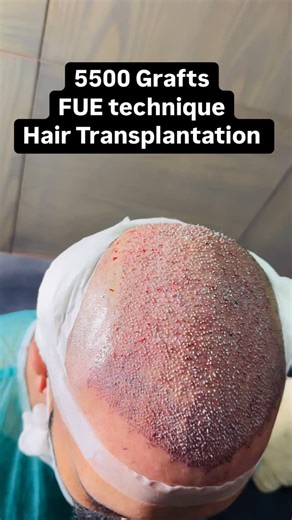 Ain Aesthetics & Medical Center | FUE (Follicular Unit Extraction) is a hair transplantation technique. ## Key aspects: 1. *Individual follicle extraction*: Hair follicles... | Instagram