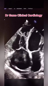 5.5K views · 43 reactions | Right Heart Thrombus - Pulmonary Embolism - The Echo Channel #TheEchoChannel #Echo #Cardiology #EmergencyMedicine | Clinical Cardiology by DocTor Game | Facebook